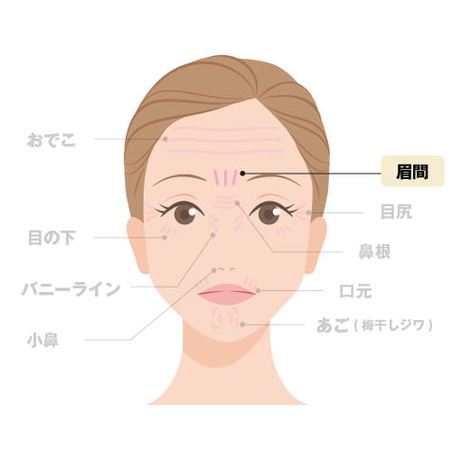 注入箇所（眉）のイラスト