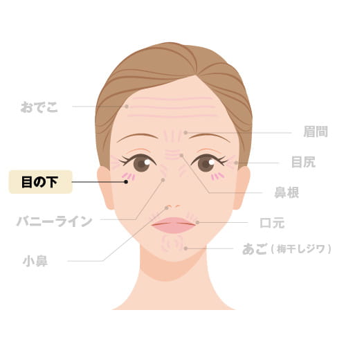注入箇所（目の下）のイラスト